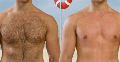 Laser hair removal works by targeting melanin. Male Brazilian Laser Hair Removal Before And After ...