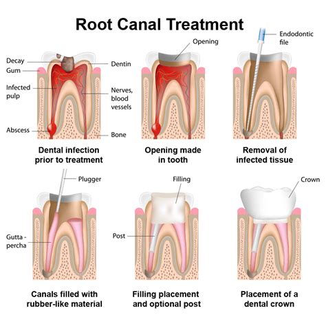 Root canals are a common procedure that your dentist will perform several times every week. Root Canal Therapy - Little Rock, AR - Restorative ...