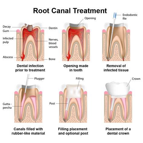 The cost varies depending on how severe the problem is and which tooth is affected. Root Canal Risks - Amity, AR - Arkadelphia, AR - Hot ...