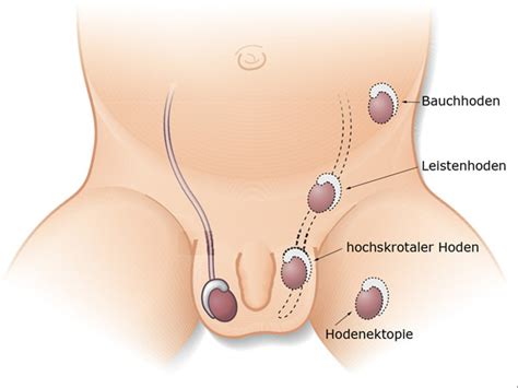 Beim umfang des penis ermittelten die forscher folgende ergebnisse: Hodenhochstand - wann behandeln? | Baby und Familie