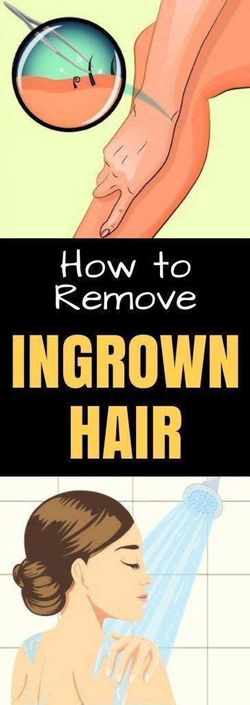 Some options for removing an ingrown hair at home include applying a topical acne cream, using a tea tree oil soak, and removing the hair with a small needle and tweezers. How to Get Rid of Ingrown Hair ? in 2020 | Ingrown hair ...