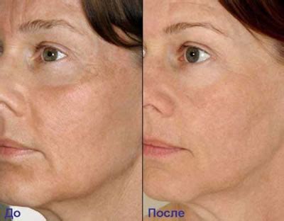 Restylane , gel per levigare la pelle - Trattamento Estetico