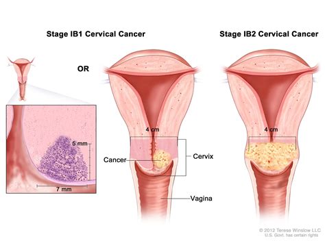Without cervical screening about one out of 90 women will develop cervical cancer and one out of 200 will die from it. 7 Signs Of Cervical Cancer That Women Need To Observe