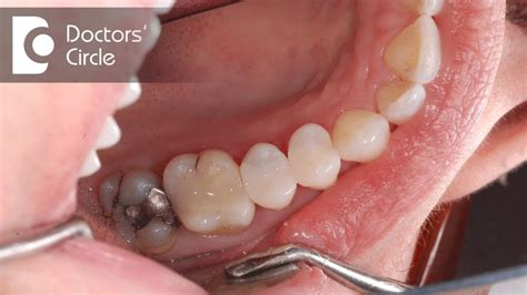 Silver fillings have been used in dentistry since 1826. Is mercury in silver tooth fillings safe? - Dr. Sowmya ...