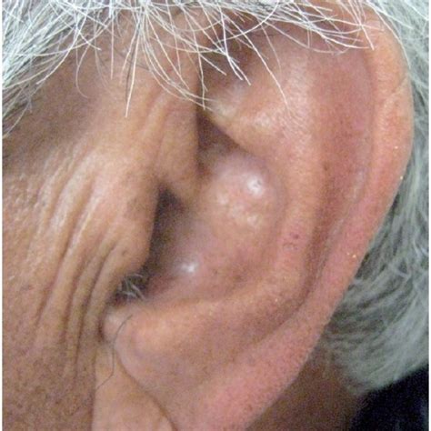 Termination of left anterior descending. The same patient with a somewhat less distinct diagonal ear lobe crease... | Download Scientific ...