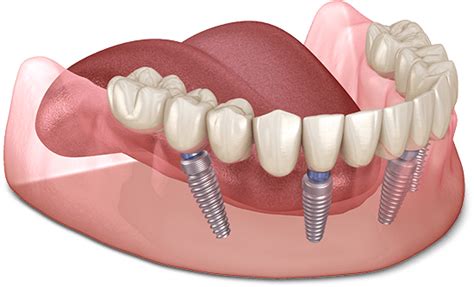 Full Mouth Dental Implants | Ocala, FL | Crystal River, FL