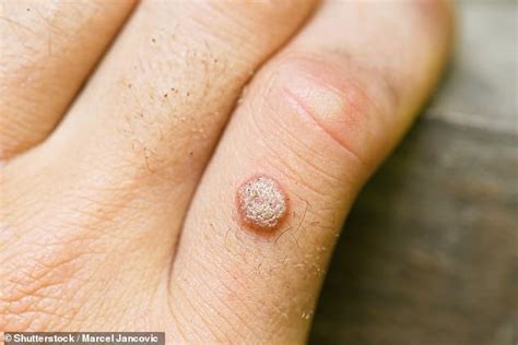 Common warts are small, grainy skin growths that occur most often on your fingers or hands. How do I get rid of these chronic warts? - fitness-gear-pro