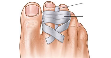 Medically reviewed by alana biggers, m.d going barefoot is a major risk factor, especially if you're walking in the dark or in an unfamiliar typical treatment for a broken toe is called buddy taping. this involves taking the broken toe and. Expert DIYer shares genius shoe hacks that I never heard ...