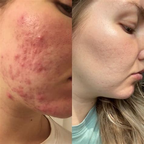 Acne in pcos women is related to high levels of male hormones like testosterone and its derivative, dihydrotestosterone (dht) (they're called male hormones but all women have testosterone just like all. PCOS & Hormonal Acne: One PCOS Diva's Success Story - PCOS ...