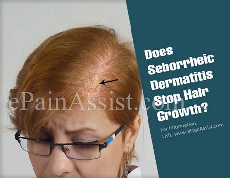 Not only is this not true, it's actually completely the opposite! Does Seborrheic Dermatitis Stop Hair Growth?|Should You ...