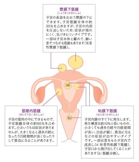 56815 12 3 4 5 6 7 8 9 10. 子宮筋腫に対する子宮動脈塞栓術の紹介｜群馬大学大学院医学 ...