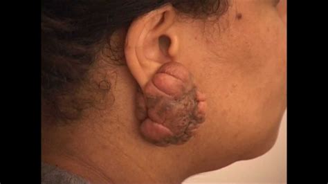 These are vital in treating scars. How to Remove Earlobe Keloids - NY Keloid Specialist - See ...