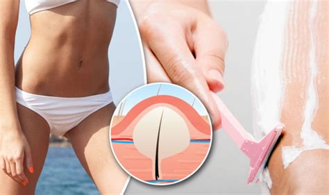 However, most of us can only trims it and there is nothing wrong with that. How to get rid of ingrown pubic hair: Easy to use and ...