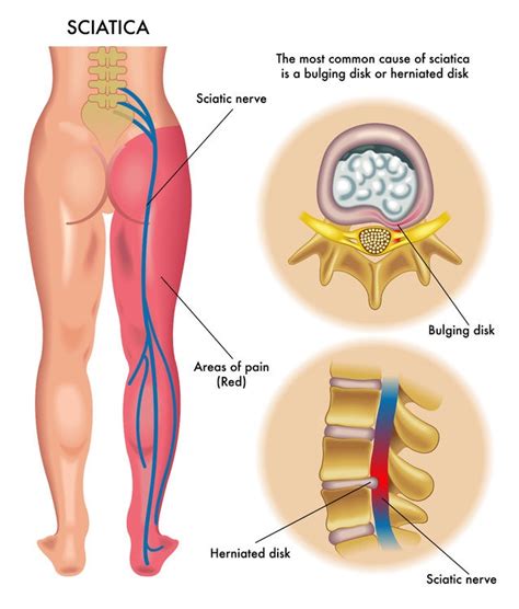 They branch out from the spinal cord in the lower back and run through the buttocks and compression, injury or inflammation of the sciatic nerve results in symptoms that typically include pain anywhere along the nerve path through the. Sciatica Symptoms & Treatment Body Organics