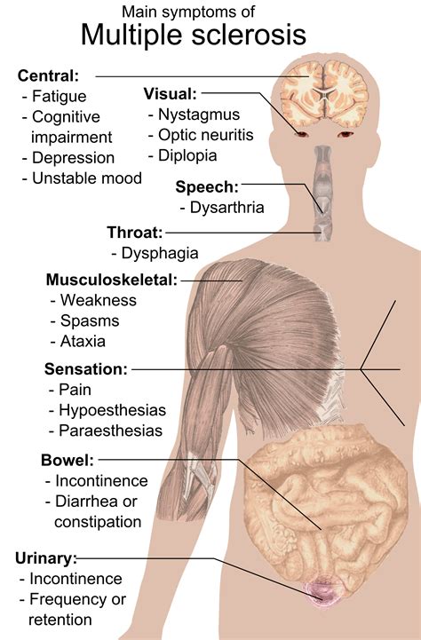 O puedes sentir que el mundo se balancea, lo que provoca una sensación de desequilibrio como si fueras arrastrado en una dirección. Síntomas de la esclerosis múltiple.