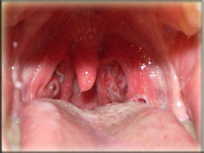 Sometimes, throat cancer looks like white patch of tissue, also known as leukoplakia. Rob Zombie se disculpa por suspender un concierto al poco ...