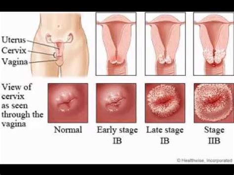 Cervical cancer rarely causes symptoms in early stages. ShweMinThar: Cervical intraepithelial neoplasia (CIN)