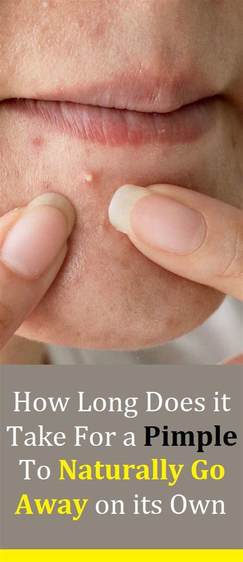 Why the hair needs to be long How Long Does it Take For a Pimple To Naturally Go Away on ...