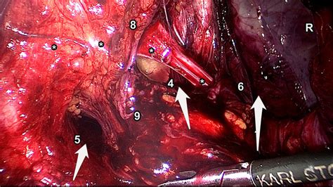 The femoral artery and femoral vein. The extraperitoneal inspection of the right groin. *: The ...