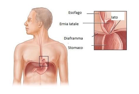 Alimenti piccanti o eccessivamente speziati (es. Ernia iatale: si può curare? - Vivere più sani