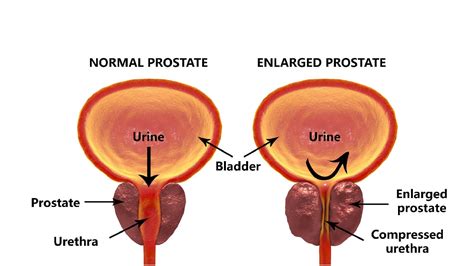 In men who have prostate cancer that is more advanced or that has spread to areas of the body beyond the prostate gland, the following symptoms may occur: Prostate Cancer in Men | Prostate Cancer Cases, Symptoms ...