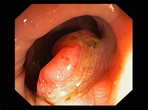 Polyps are growths that could eventually develop into tumors, though relatively few do. Colorectal Cancer - Gastrointestinal Disorders - Merck ...