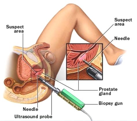 When i said i was done. A safer way to biopsy the prostate — Dr Jeremy Grummet ...