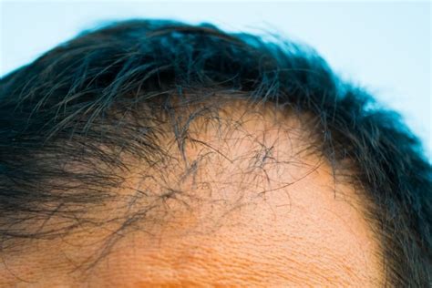 すべてのカタログ: オリジナル はげ ちゃ びん 由来