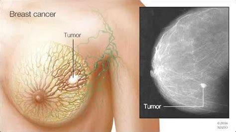 They want some of your tender loving care. Breast cancer study provides critical information on tumor ...