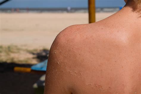 Sunburn is skin damage and your body's response to try to repair it. Do you know your skin cancer risk? - MoleMap