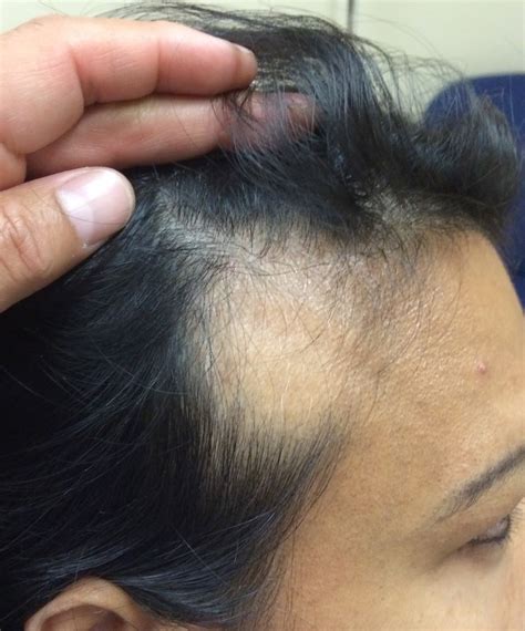 Poliosis may be associated with autoimmune diseases including alopecia areata, as described in our case. Alopecia Areata Hair Regrowth | Spefashion