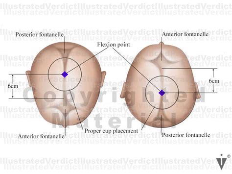 However, when used correctly and with gentleness they can achieve a controlled, atraumatic delivery. Stock Pregnancy / Delivery: Vacuum / Forceps — Illustrated ...