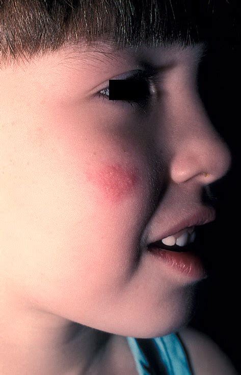 I also thinks it's awesome that you have built up a nice little nest egg for yourself. Herpes on Face Pictures - 49 Photos & Images / illnessee.com