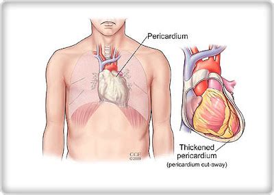 Mesothelioma is a type of cancer that develops from the thin layer of tissue that covers many of the internal organs (known as the mesothelium). Pericardial Mesothelioma | Vinson Law Office PA