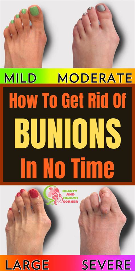 Tylenol® rapid release gelcaps help relieve minor aches and pains & reduces fever. How To Get Rid Of Bunions In No Time | Get rid of bunions ...