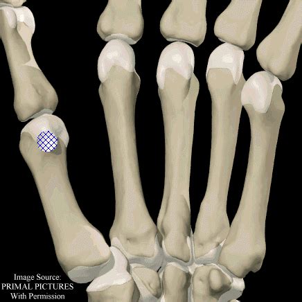 Thumb Radial MCP Sesamoid