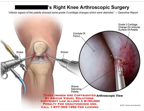 New research suggests that in many cases the surgery is not effective. Right Knee Arthroscopic Surgery