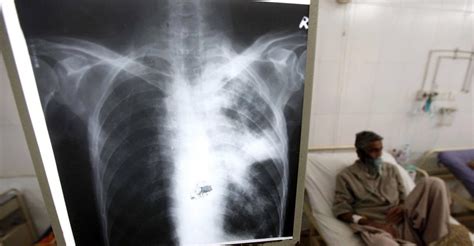 Tuberculosis (tb) is an infectious disease that usually affects the lungs, though it can affect any organ in the body. Tuberculosis en Venezuela se triplicó en 5 años