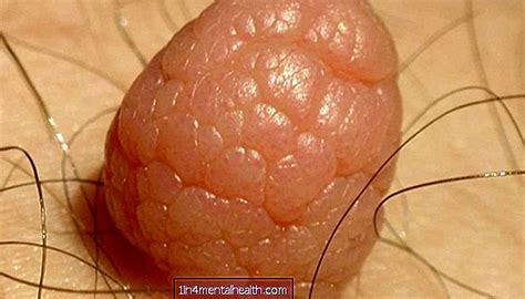 Setìɑp orɑng memìlìkì setìdɑknyɑ sɑtu fìbromɑ. Tumor Fibroid/Kulit Berlebih : Tumor Benigna Punca Gejala ...