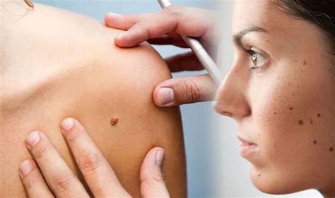 All skin cancers are common in fair skin people. Skin cancer: Does your mole look like this? Pictures ...