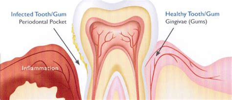 We did not find results for: Gum Disease Information | Gum Disease Treatment NYC, Long ...