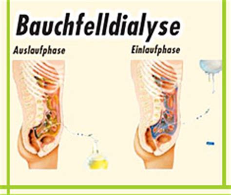 In den meisten fällen erfolgt die dialyse in dialysezentren. Bauchfelldialyse: mehr Bequemlichkeit für Patienten ...