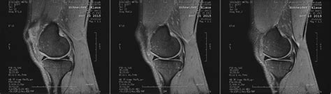 1, innerer schenkelmuskel (musculus vastus medialis). MRT Knie rechts