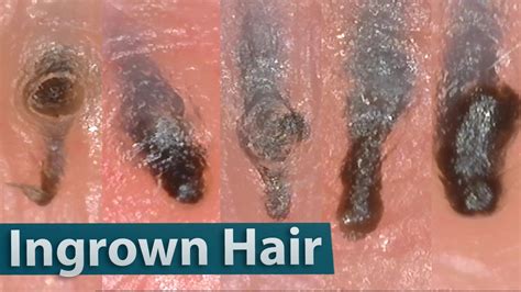 Ingrown hairs are formed in the same way if you use waxing etc., particularly if your hair is broken off what's the best way to treat ingrown pubic hairs? Ingrown Hair Removal Close up 200X | 埋没毛を除去 - YouTube