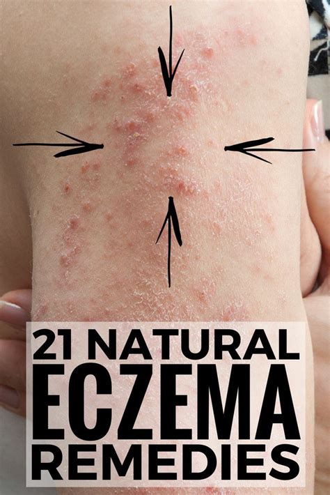 This was eczema, a condition i hadn't experienced since its signature pinot noir tone and maddening itch plagued my inner arms and the backs of my knees when i was in primary school. How to Stop Itching due to Dry Skin, Eczema, Psoriasis ...