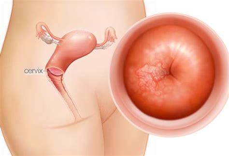 If this happens, it is usually about 3 months after treatment starts. Cervical cancer