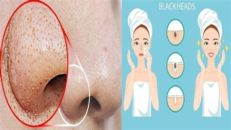 These could be painful red blemishes, whiteheads or blackheads that can be treated with skin care products to help keep the. Pin auf nose-black-head