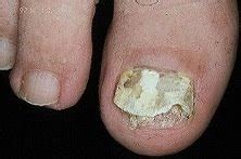 El tejido alrededor de la uña también puede engrosarse. Grupo Fivasa: Hongos en las uñas de los pies