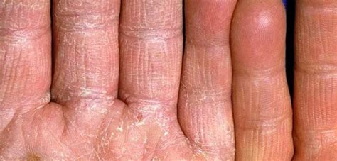 Qué es el hongo negro: Hongo de la mano (tiña del manú): causas, síntomas y ...