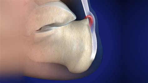 Bei der haglund exostose handelt es sich um einen knöchernen überstand der ferse, was zu einer bedrängung der achillessehne führen kann. Ortho Blog | Haglund's Deformity (Retrocalcaneal Bursitis ...